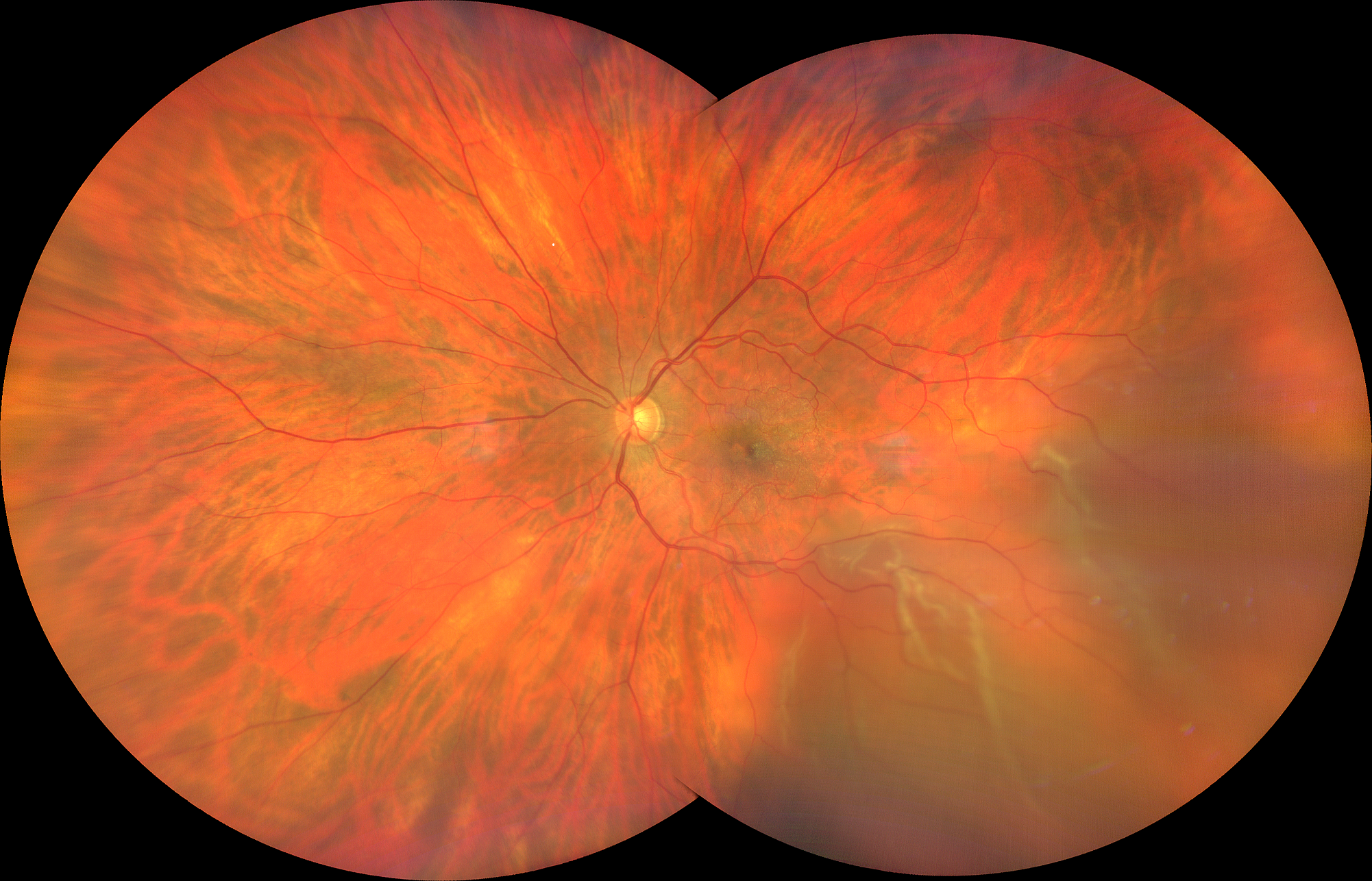 Distacco di retina con imaging Ultra Widefield Imaging